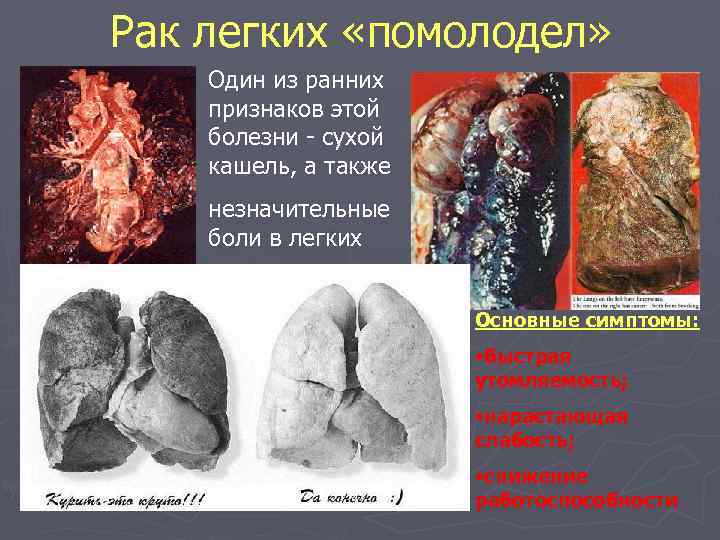 Рак легких «помолодел» Один из ранних признаков этой болезни - сухой кашель, а также