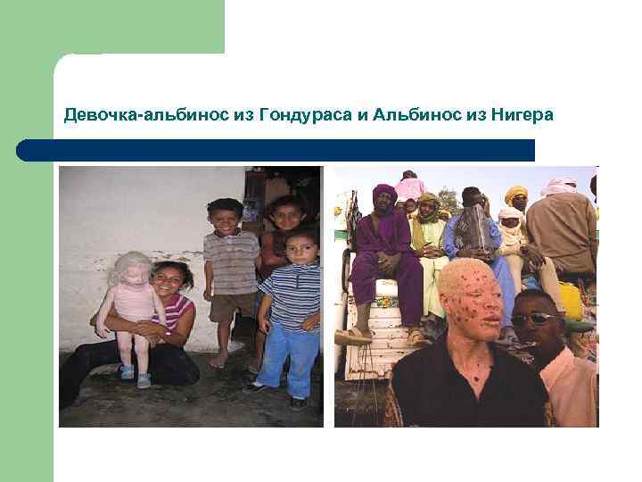 Девочка-альбинос из Гондураса и Альбинос из Нигера 