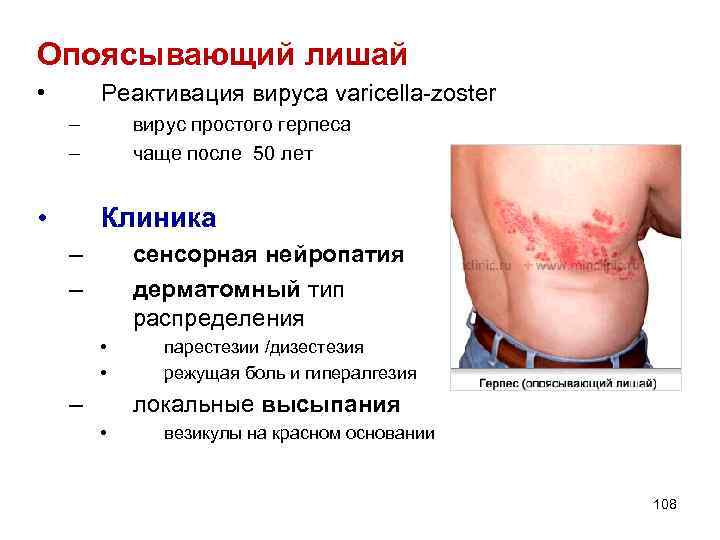 Опоясывающий лишай • Реактивация вируса varicella-zoster – – • вирус простого герпеса чаще после