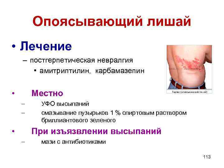 Опоясывающий лишай • Лечение – постгерпетическая невралгия • амитриптилин, карбамазепин • Местно – –