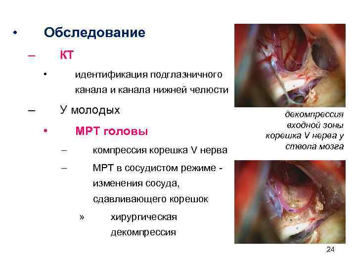  • Обследование – КТ • идентификация подглазничного канала и канала нижней челюсти –