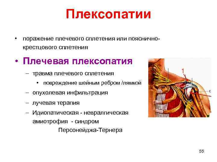 Плексопатии • поражение плечевого сплетения или поясничнокрестцового сплетения • Плечевая плексопатия – травма плечевого