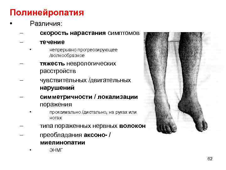 Дистальная моторная полинейропатия