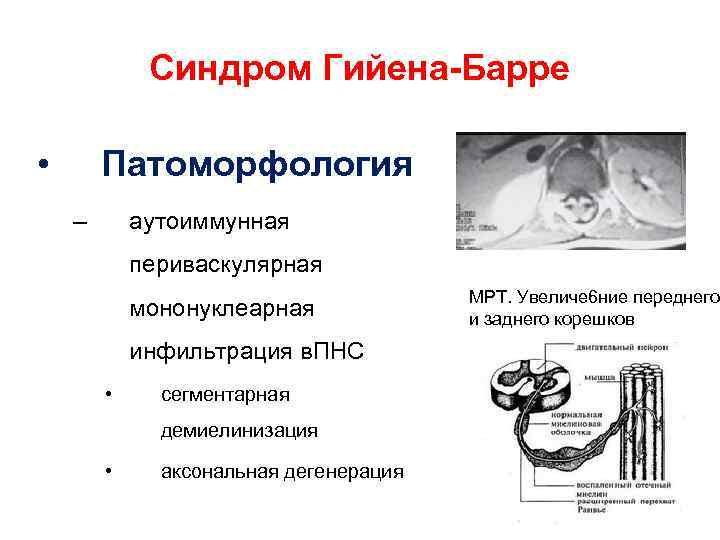 Синдром Гийена-Барре • Патоморфология – аутоиммунная периваскулярная мононуклеарная МРТ. Увеличе 6 ние переднего и