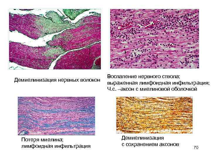 Демиелинизация нервных волокон Потеря миелина; лимфоидная инфильтрация Воспаление нервного ствола; выраженная лимфоидная инфильтрация; Ч.