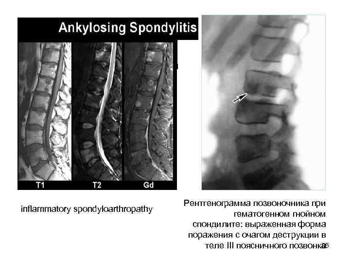 inflammatory spondyloarthropathy Рентгенограмма позвоночника при гематогенном гнойном спондилите: выраженная форма поражения с очагом деструкции