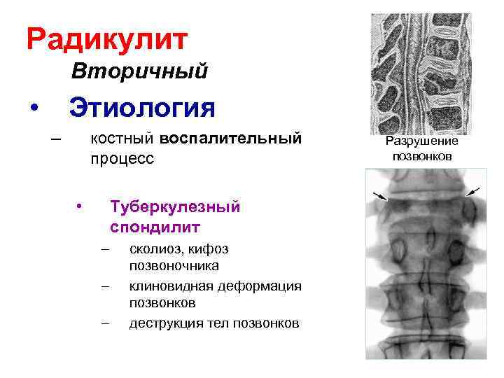 Радикулит Вторичный • Этиология – костный воспалительный процесс • Разрушение позвонков Туберкулезный спондилит –