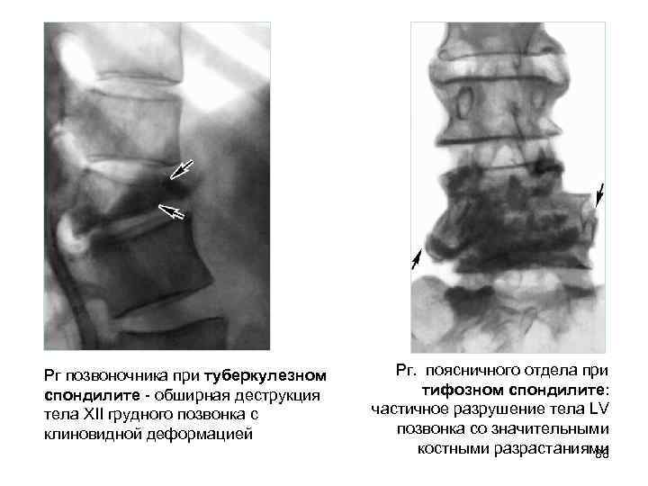 Деформация позвонков. Спондилит поясничного отдела позвоночника рентген. Клиновидная деформация тела позвонка кт. Деформирующий спондилит. Спондилит поясничного отдела позвоночника что это такое.