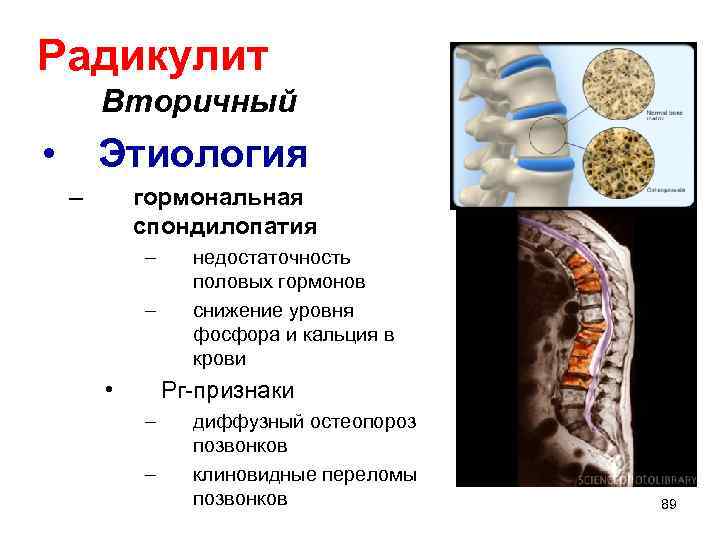Радикулит Вторичный • Этиология – гормональная спондилопатия – – • недостаточность половых гормонов снижение