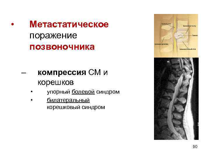 Клиническая картина компрессии корешков конского хвоста отличается от компрессии конуса и конуса