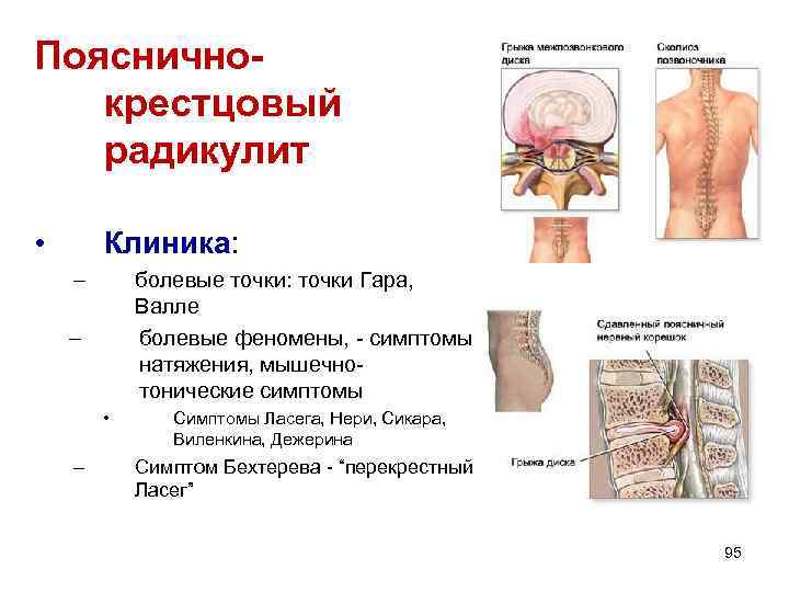Поясничнокрестцовый радикулит • Клиника: – болевые точки: точки Гара, Валле болевые феномены, - симптомы
