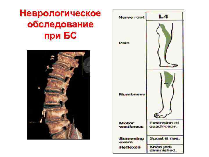 Неврологическое обследование при БС 