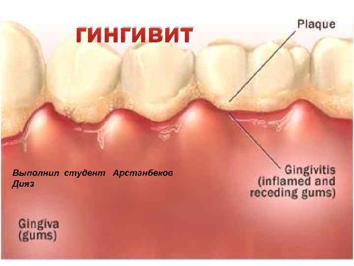 гингивит Выполнил студент Арстанбеков Дияз 
