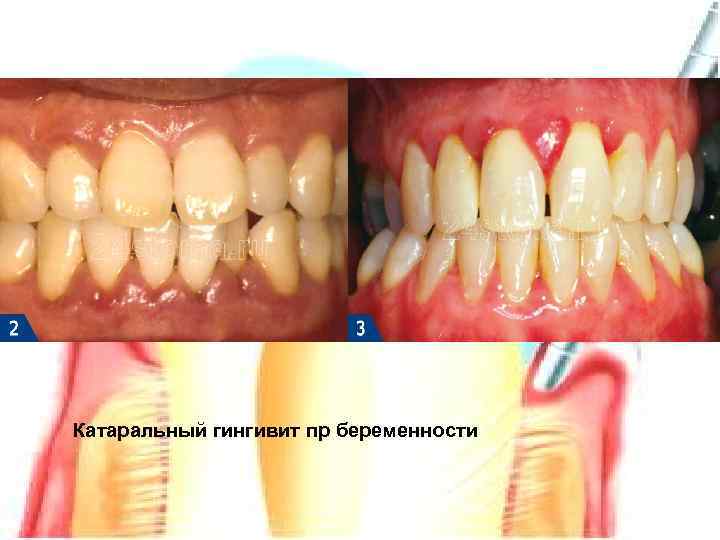 Катаральный гингивит пр беременности 