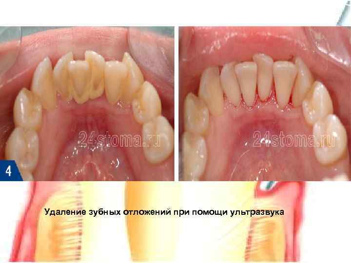 Удаление зубных отложений при помощи ультразвука 