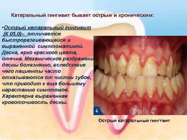 Катаральный гингивит бывает острым и хроническим: • Острый катаральный гингивит (К 05. 0)– отличается