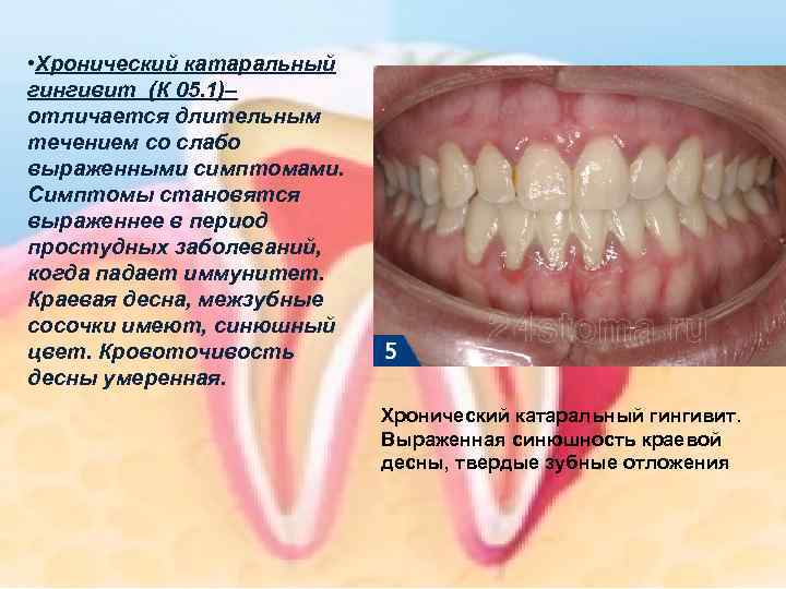  • Хронический катаральный гингивит (К 05. 1)– отличается длительным течением со слабо выраженными