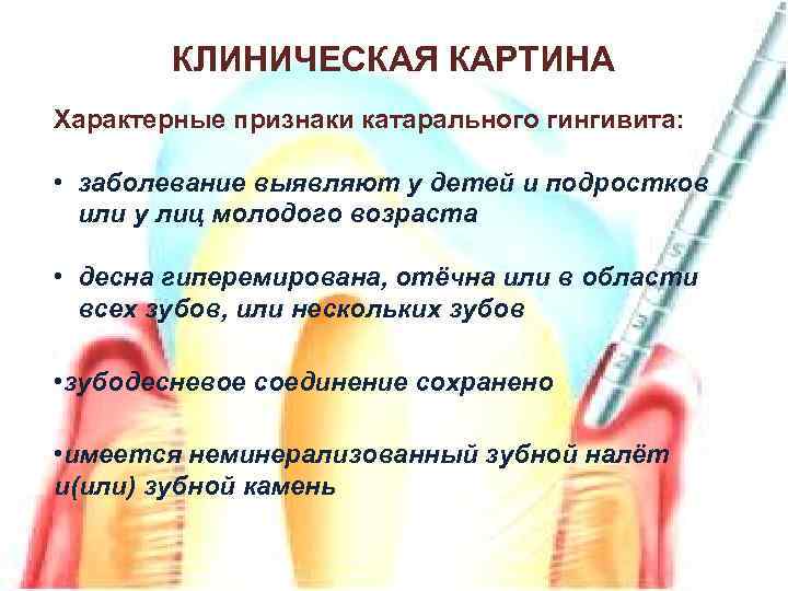 КЛИНИЧЕСКАЯ КАРТИНА Характерные признаки катарального гингивита: • заболевание выявляют у детей и подростков или