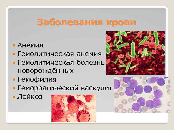 Заболевание крови гемофилия
