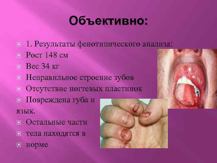 Объективно: 1. Результаты фенотипического анализа: Рост 148 см Вес 34 кг Неправильное строение зубов