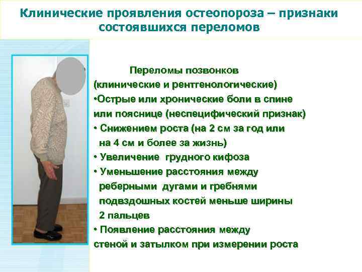 Клинические проявления остеопороза – признаки состоявшихся переломов Переломы позвонков (клинические и рентгенологические) • Острые