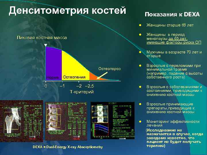 Денситометрия критерии. Денситометрия. Показания денситометрии норма. Остеопороз показатели денситометрии нормы. Денситометрия при остеопорозе.