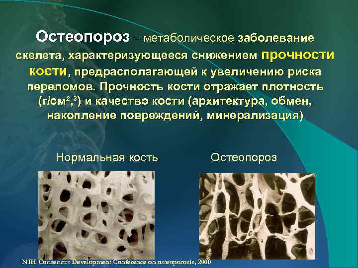 Остеопороз – метаболическое заболевание скелета, характеризующееся снижением прочности кости, предрасполагающей к увеличению риска переломов.