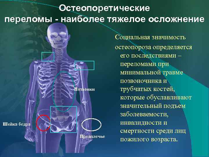 Остеопоретические переломы - наиболее тяжелое осложнение Позвонки Шейка бедра Предплечье Социальная значимость остеопороза определяется