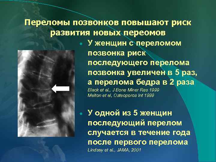 Переломы позвонков повышают риск развития новых переомов · У женщин с переломом позвонка риск