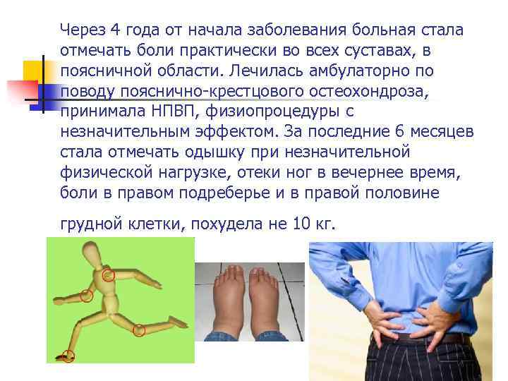 Через 4 года от начала заболевания больная стала отмечать боли практически во всех суставах,