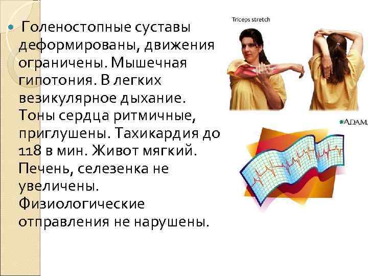  Голеностопные суставы деформированы, движения ограничены. Мышечная гипотония. В легких везикулярное дыхание. Тоны сердца