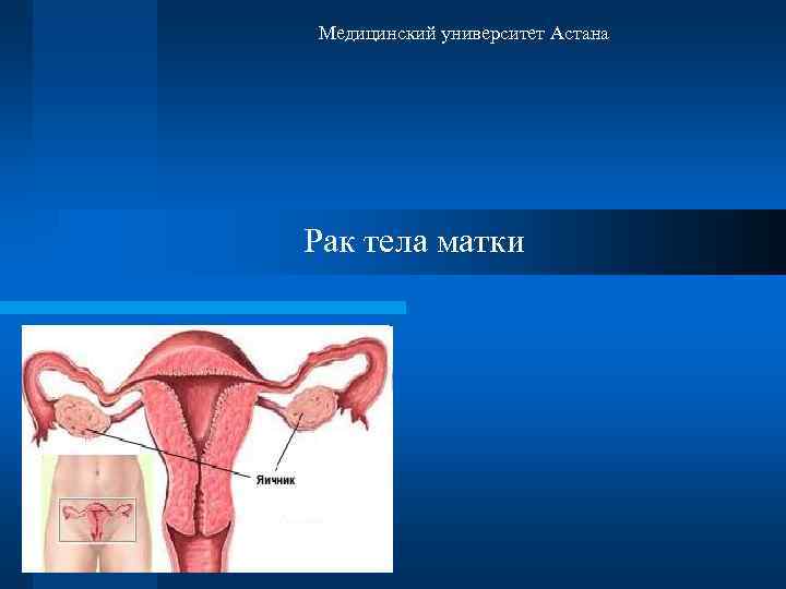 Медицинский университет Астана Рак тела матки 