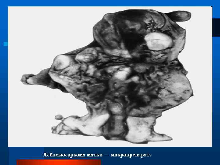 Лейомиосаркома матки — макропрепарат. 