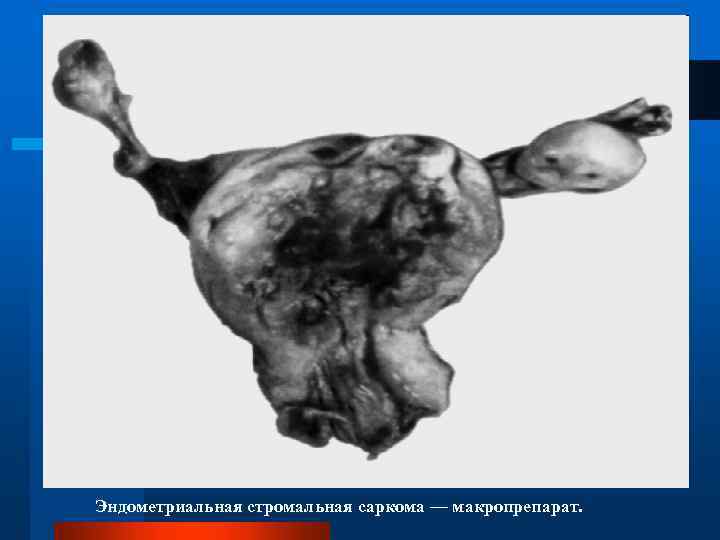 Эндометриальная стромальная саркома — макропрепарат. 