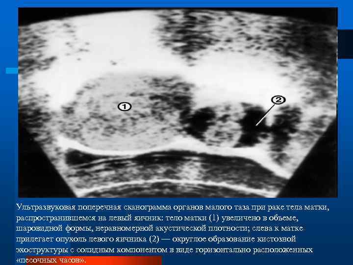Ультразвуковая поперечная сканограмма органов малого таза при раке тела матки, распространившемся на левый яичник: