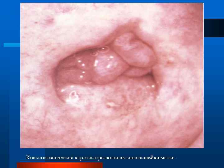 Кольпоскопическая картина при полипах канала шейки матки. 