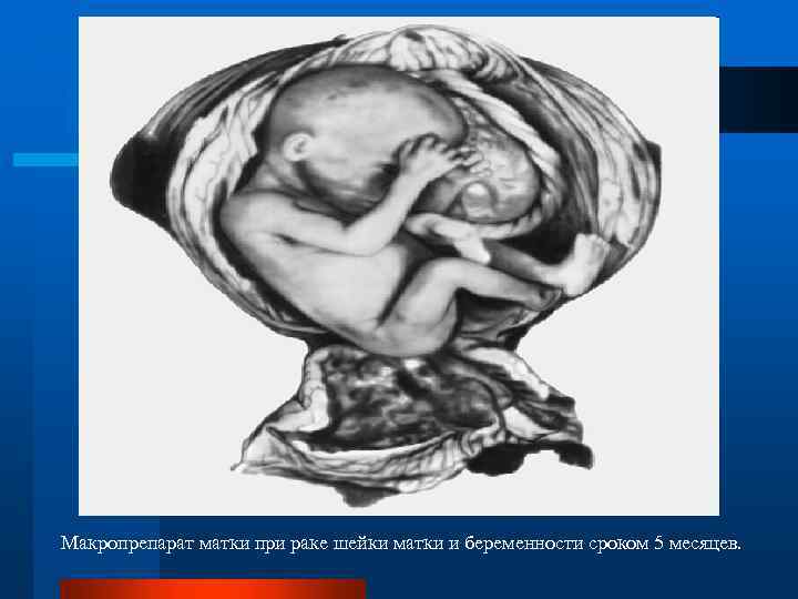 Макропрепарат матки при раке шейки матки и беременности сроком 5 месяцев. 