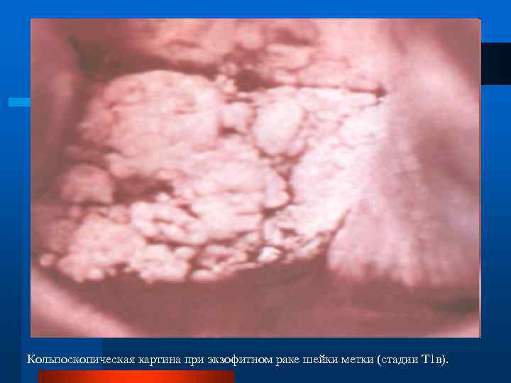Кольпоскопическая картина при экзофитном раке шейки метки (стадии Т 1 в). 