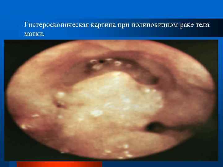 Гистероскопическая картина при полиповидном раке тела матки. 