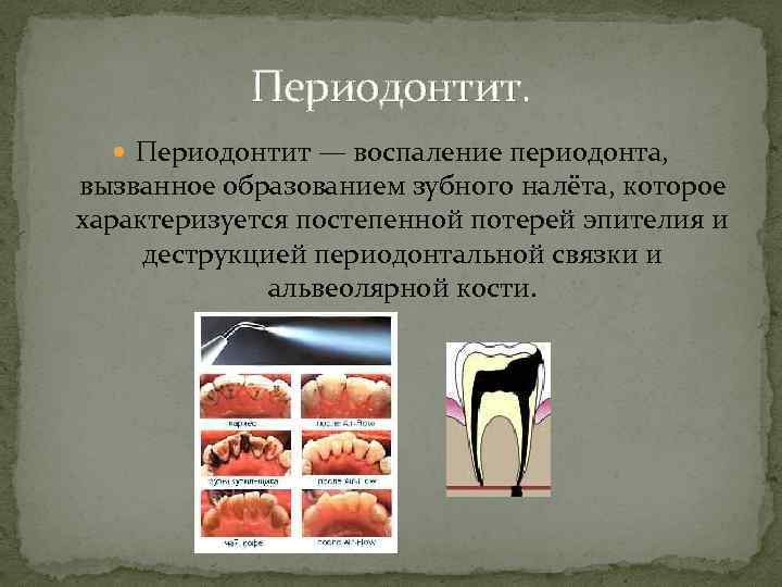 Периодонтит. Периодонтит — воспаление периодонта, вызванное образованием зубного налёта, которое характеризуется постепенной потерей эпителия
