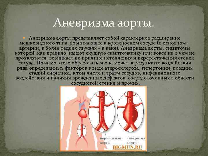 Аневризма аорты. Аневризма аорты представляет собой характерное расширение мешковидного типа, возникающее в кровеносном сосуде