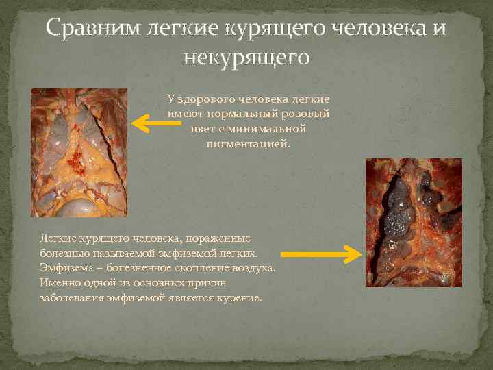 Сравним легкие курящего человека и некурящего У здорового человека легкие имеют нормальный розовый цвет
