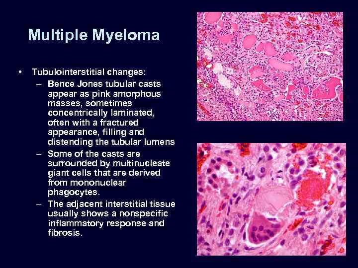 Multiple Myeloma • Tubulointerstitial changes: – Bence Jones tubular casts appear as pink amorphous
