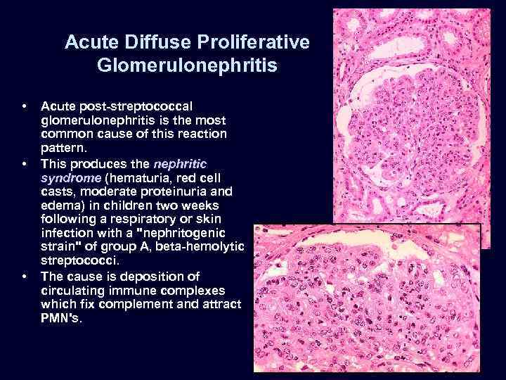 Acute Diffuse Proliferative Glomerulonephritis • • • Acute post-streptococcal glomerulonephritis is the most common