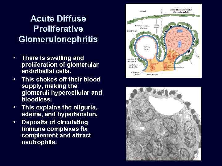 Acute Diffuse Proliferative Glomerulonephritis • There is swelling and proliferation of glomerular endothelial cells.