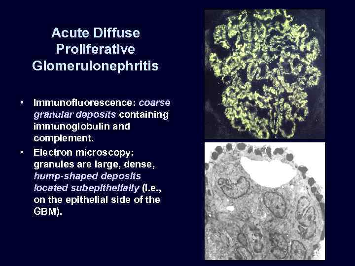 Acute Diffuse Proliferative Glomerulonephritis • Immunofluorescence: coarse granular deposits containing immunoglobulin and complement. •