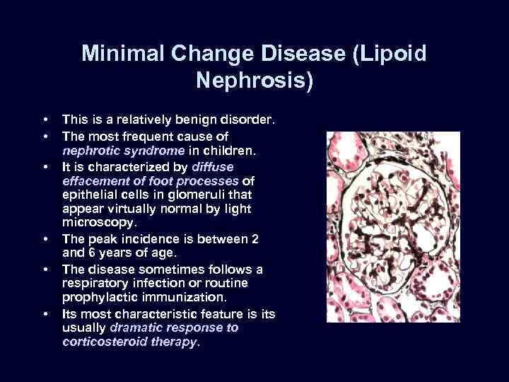 Minimal Change Disease (Lipoid Nephrosis) • • • This is a relatively benign disorder.