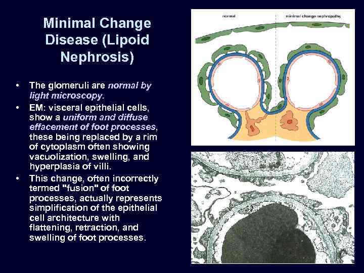 Minimal Change Disease (Lipoid Nephrosis) • • • The glomeruli are normal by light