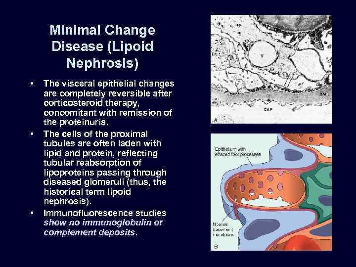 Minimal Change Disease (Lipoid Nephrosis) • • • The visceral epithelial changes are completely