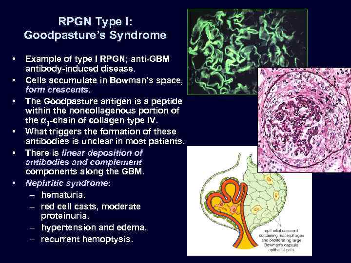 RPGN Type I: Goodpasture’s Syndrome • • • Example of type I RPGN; anti-GBM